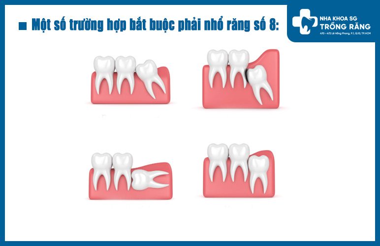 Các trường hợp nhổ răng số 8 trường hợp nhổ răng số 8