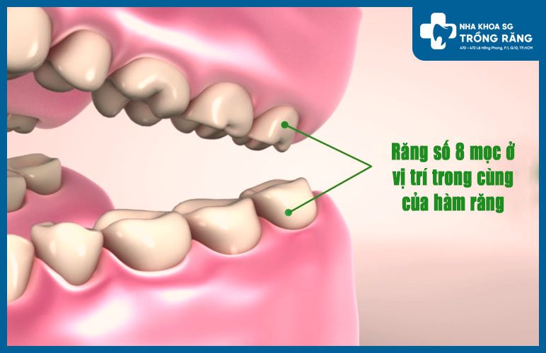 vị trí mọc răng số 8 vị trí mọc răng số 8
