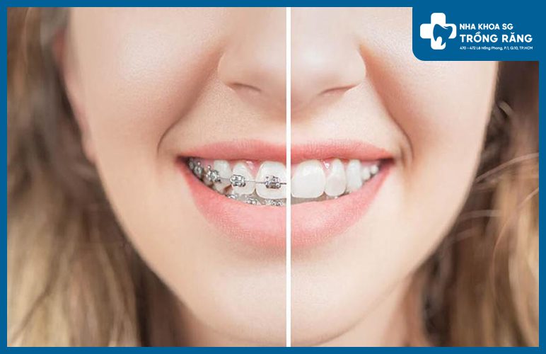 Hinh anh nieng rang Niềng răng là gì? Khi nào thì cần phải niềng răng?