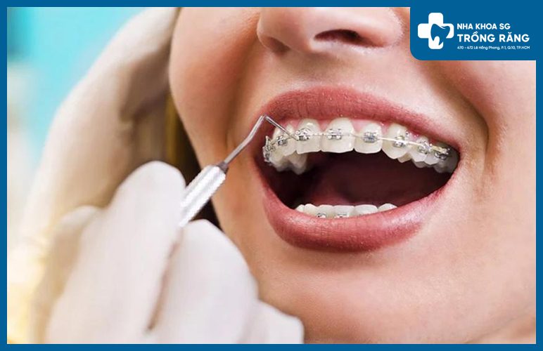 Khi nao thi can phai nieng rang Niềng răng là gì? Khi nào thì cần phải niềng răng?