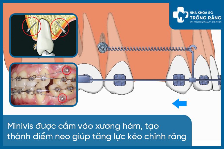 Minivis trong chinh nha Minivis trong chỉnh nha: Khái niệm, vai trò và đối tượng phù hợp