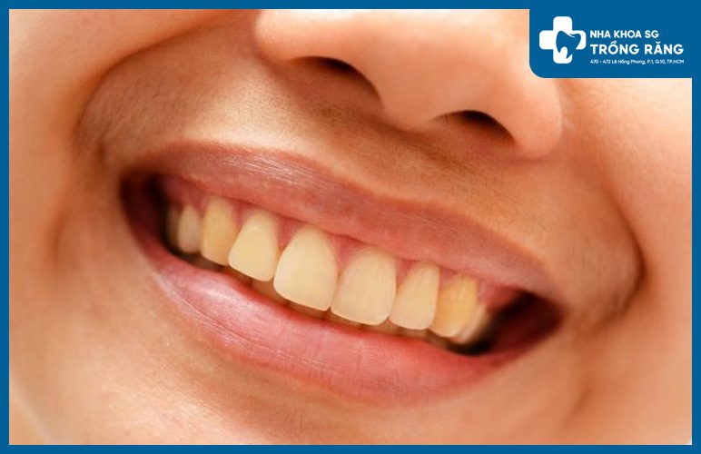 Nguyen nhan nao khien rang ban bi o vang Răng bị ố vàng phải làm sao? Nguyên nhân, cách trị