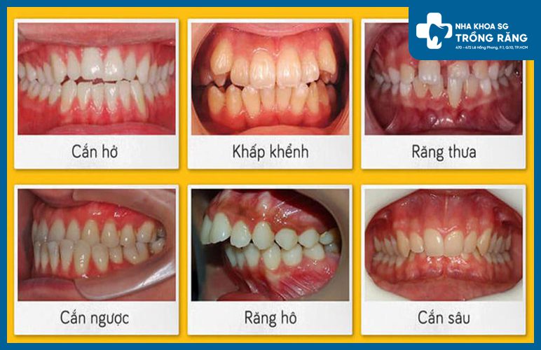 Nhung truong hop can thiet phai nieng rang Niềng răng là gì? Khi nào thì cần phải niềng răng?