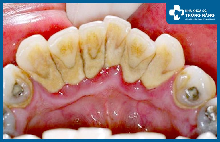 Rang bi den o mat trong anh huong gi den suc khoe Răng bị đen ở mặt trong là do nguyên nhân gì? Có tẩy trắng được không?