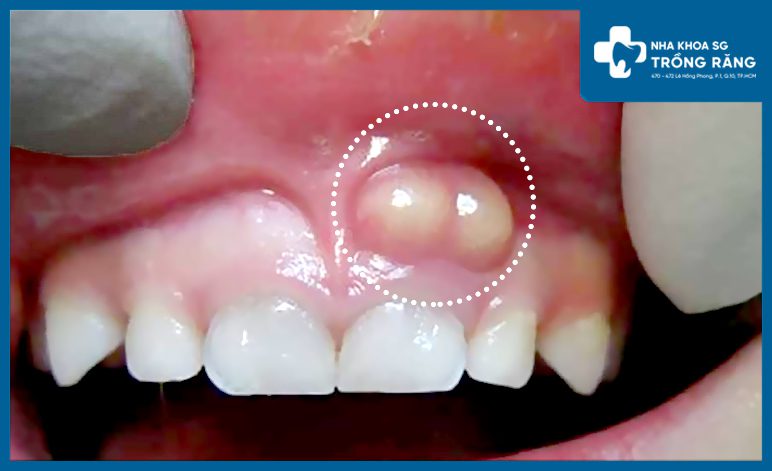 Răng không sâu nhưng bị đau - Vấn đề là do đâu?