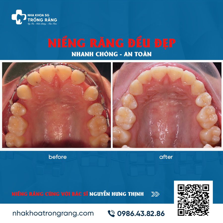 Bật mí nha khoa gần quận 4 nổi tiếng niềng răng đẹp