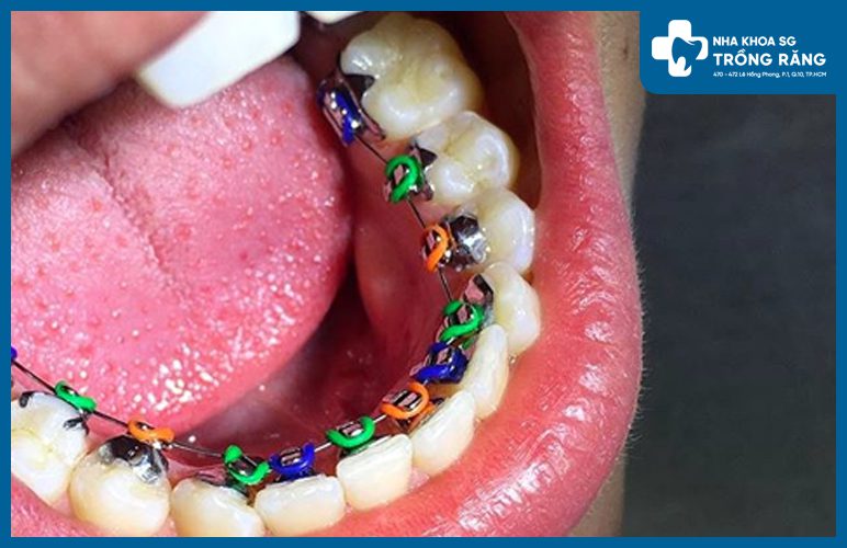 Bật mí nha khoa gần quận 4 nổi tiếng niềng răng đẹp