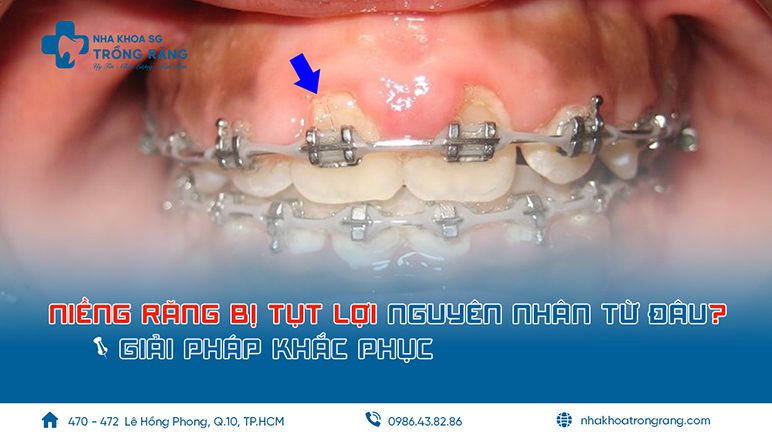 nieng rung bi tut loi Niềng răng bị tụt lợi nguyên nhân từ đâu? giải pháp khắc phục