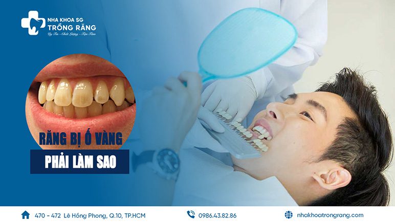 rang bi o vang phai lam sao Răng bị ố vàng phải làm sao? Nguyên nhân, cách trị