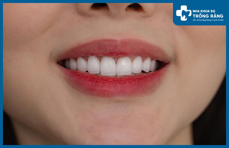 Bọc sứ răng hàm trên chọn loại nào tốt?