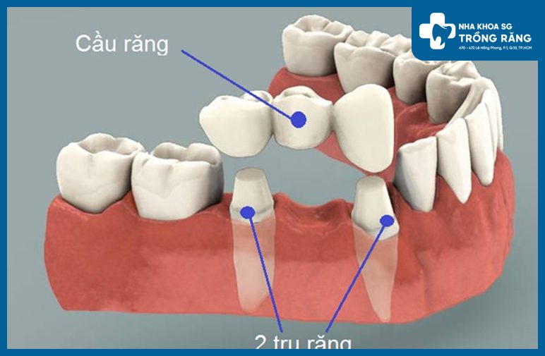 Cau rang su doi voi truong hop chan rang ngan cầu răng sứ cho răng nhai