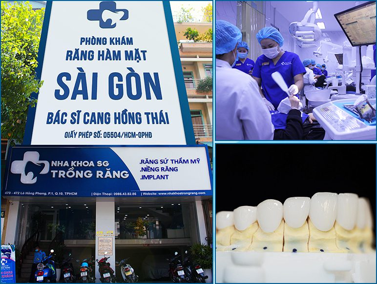 Dia chi lam rang su titan hang dau Viet Nam Răng sứ titan có bị đen không?