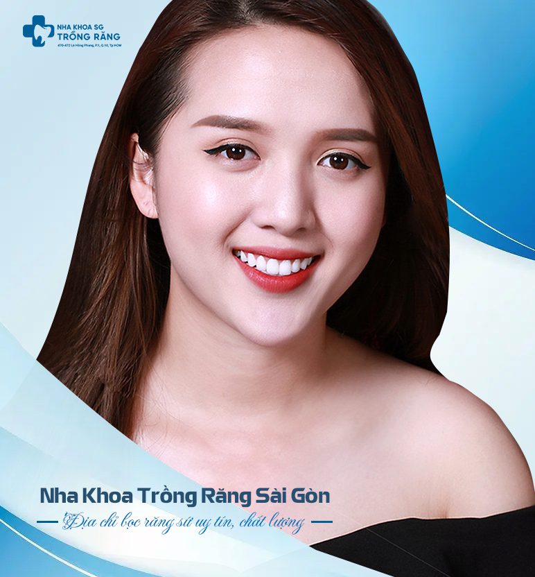 Hinh anh sau khi boc rang su khong can mai Bọc răng sứ không cần mài răng giá bao nhiêu?