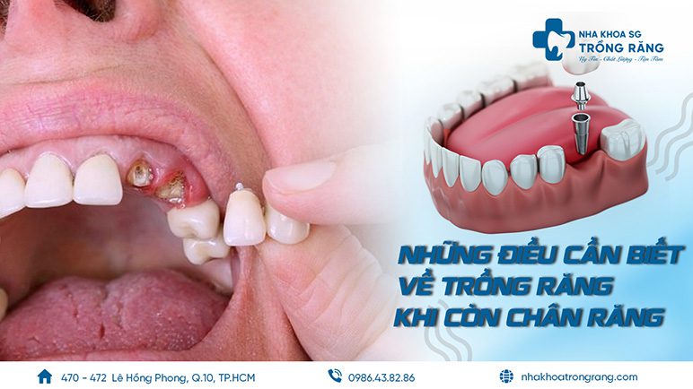 Nhung dieu can biet ve trong rang khi con chan rang Những điều cần biết về trồng răng khi còn chân răng