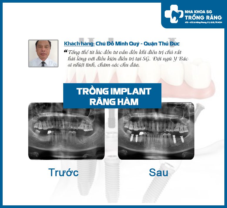Implant neodent hỗ trợ lên răng tức thì, tích hợp nhanh