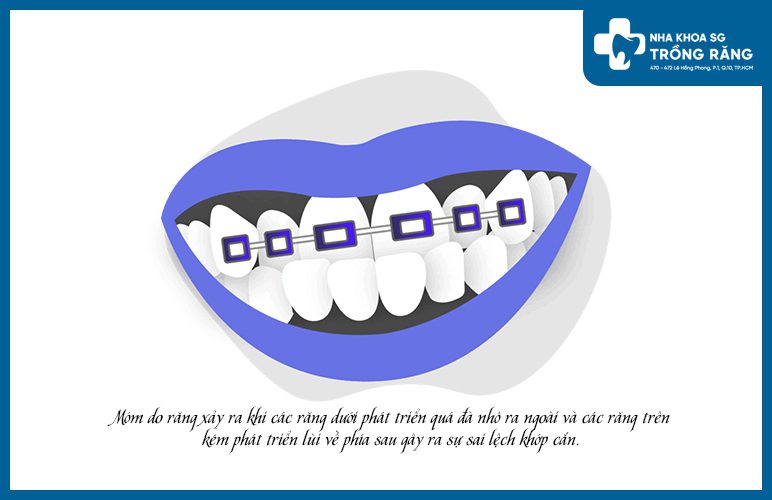 Bị móm do răng làm sao để khắc phục hiệu quả?