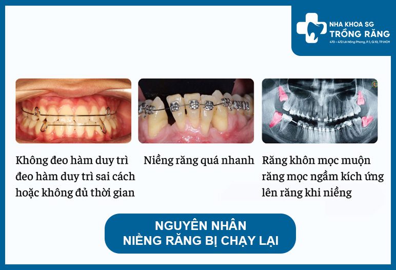 Nguyên nhân niềng răng bị chạy lại và cách xử lý