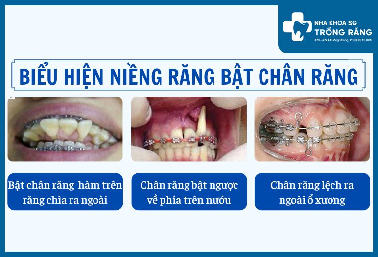 bieu hien nieng rang bi bat chan rang ra ngoai Niềng răng bị bật chân răng đâu là nguyên nhân?