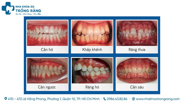 Niềng răng bị lệch khớp cắn - cách xử lý giúp hàm cân đối hài hòa