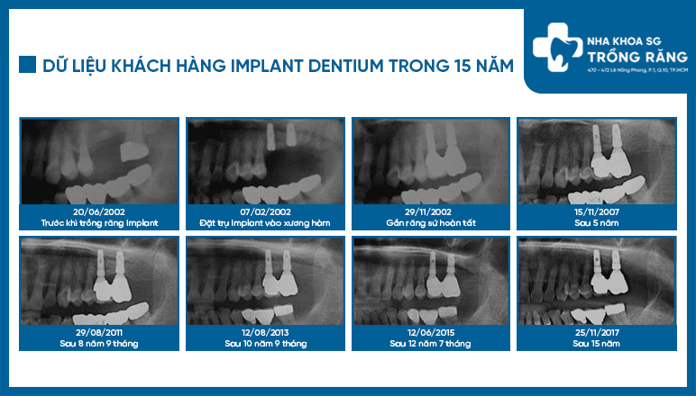 Du lieu trong rang implant dentium sau 15 nam Du lieu trong rang implant dentium sau 15 nam