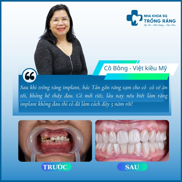 cam nhan trong rang implant cam nhan trong rang implant