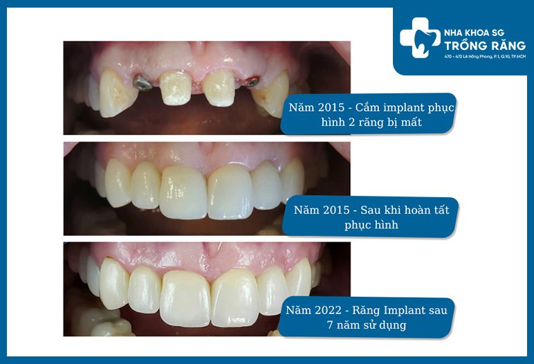 rang implant rang implant