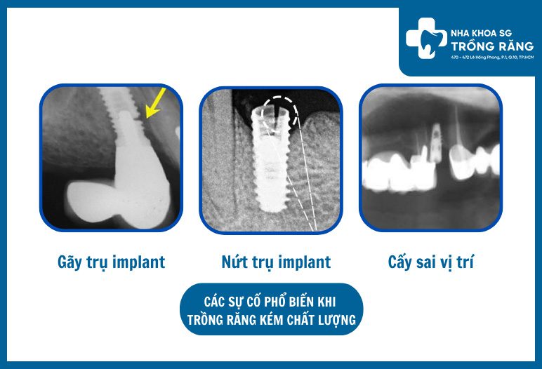 su co khi trong rang implant kem chat luong su co khi trong rang implant kem chat luong