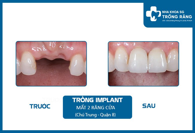 Làm răng giả bền vững trọn đời với trụ implant nobel
