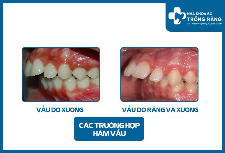 cac truong hop vau cac truong hop vau