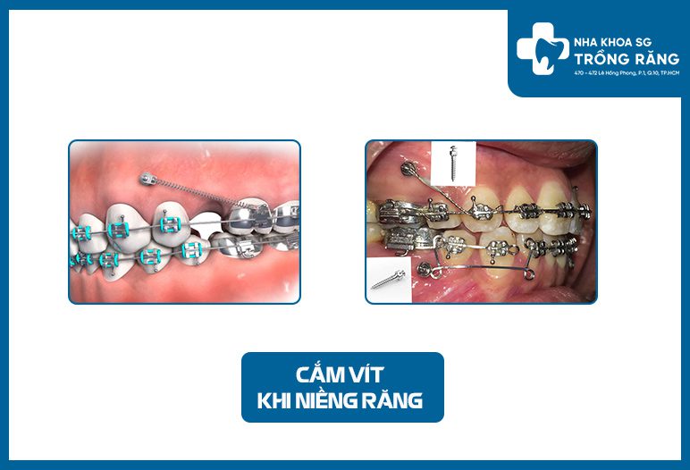 cam vit khi nieng rang co dau khong cam vit khi nieng rang co dau khong