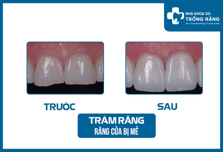 tram rang cua bi me tram rang cua bi me