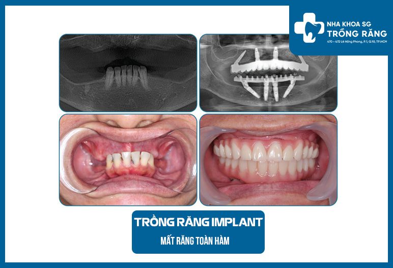 Trồng răng implant toàn hàm