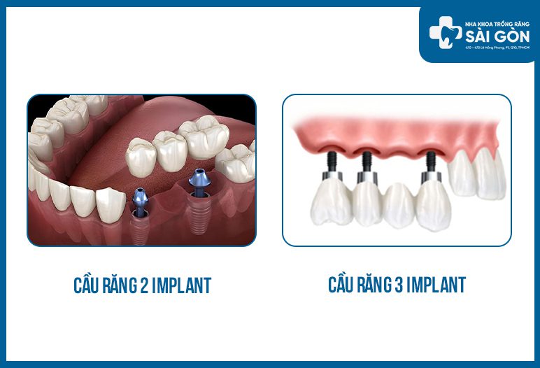 cầu răng implant