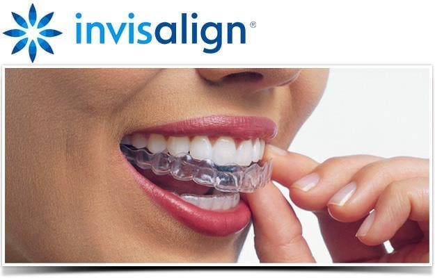 Niềng răng trong suốt Invisalign - Sự lựa chọn thông minh cho nụ cười hoàn hảo