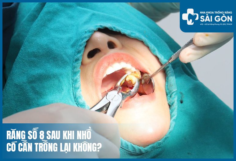 nhổ răng số 8 có cần trồng lại không