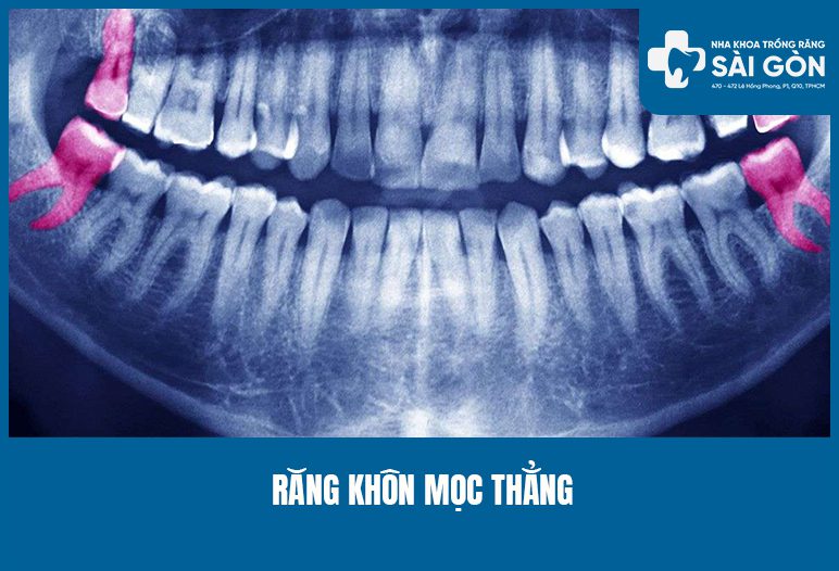 răng khôn mọc thẳng có nên nhổ không