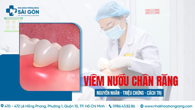 Viêm nướu chân răng