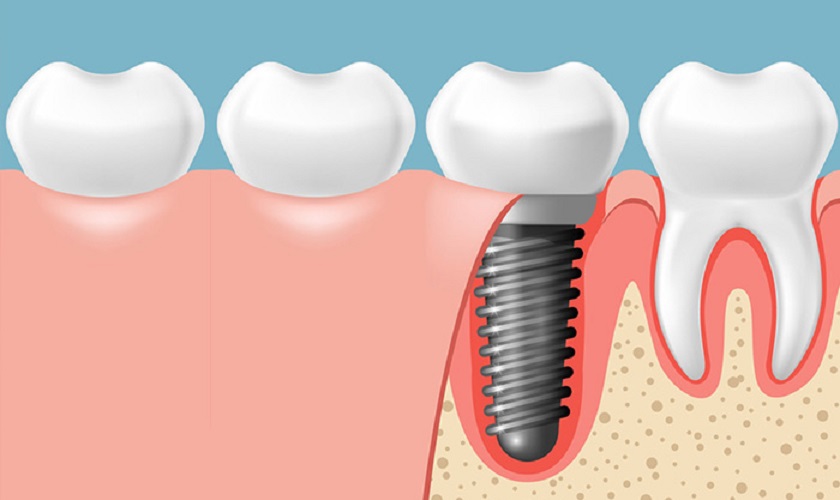 Địa chỉ trồng răng implant tphcm uy tín, chất lượng