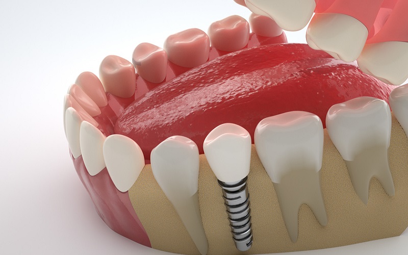 Địa chỉ trồng răng implant tphcm uy tín, chất lượng