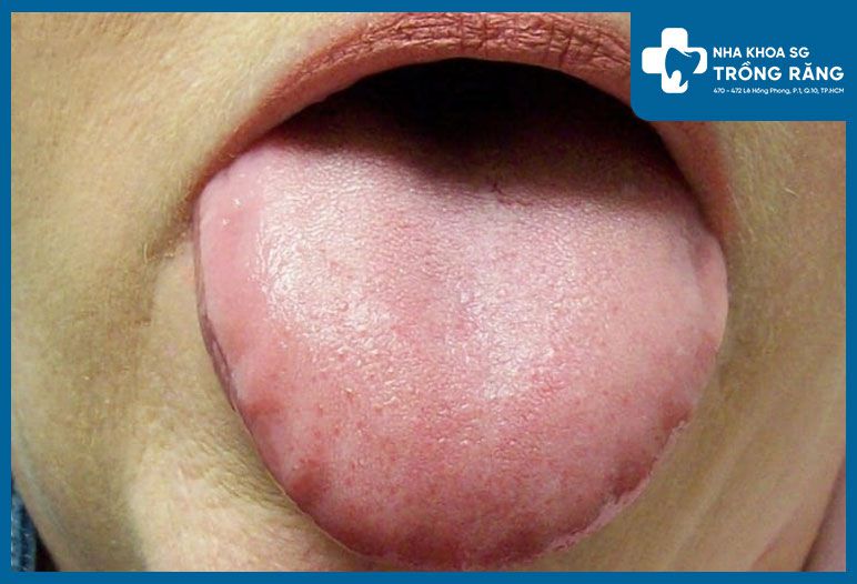 Nhú lưỡi xuất hiện một số hạt đỏ nhỏ khiến người bệnh cảm thấy khó chịu