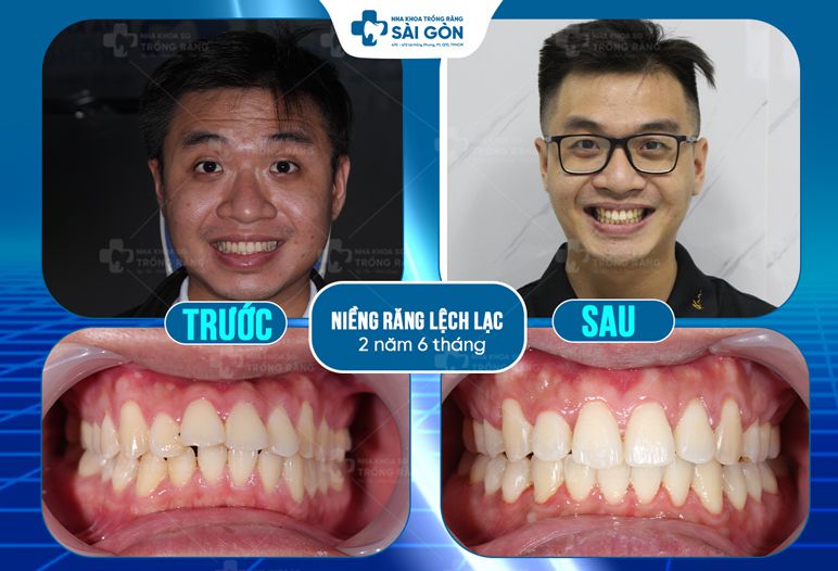 Khách hàng niềng răng lệch lạc tại Nha Khoa Trồng Răng Sài Gòn