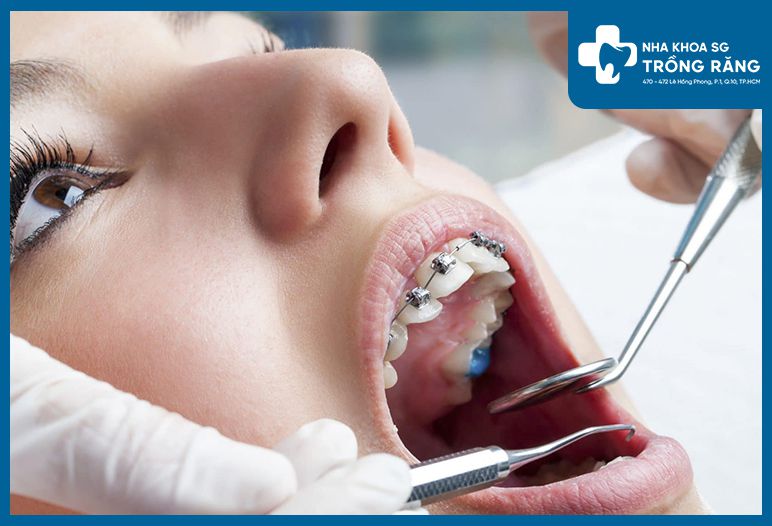 niềng răng trả góp 0% lãi suất tại Nha Khoa Trồng Răng Sài Gòn