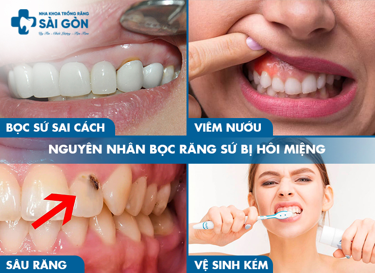 Bọc răng sứ có bị hôi miệng không - nguyên nhân gây hôi miệng khi bọc sứ