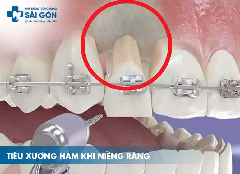 Niềng răng bị tiêu xương hàm