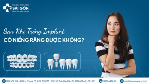 có thể niềng răng sau khi trồng implant không