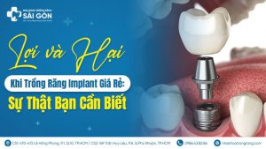 trồng implant giá rẻ