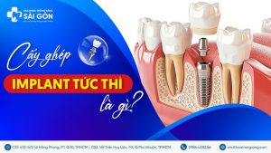 cấy ghép implant tức thì