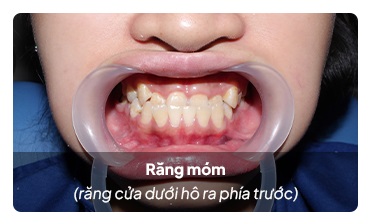 nieng rang mom Niềng răng móm