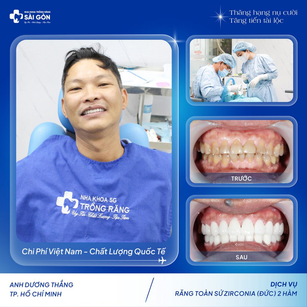 Anh Dương Thắng Bọc 21 Răng Sứ Zirconia của Đức